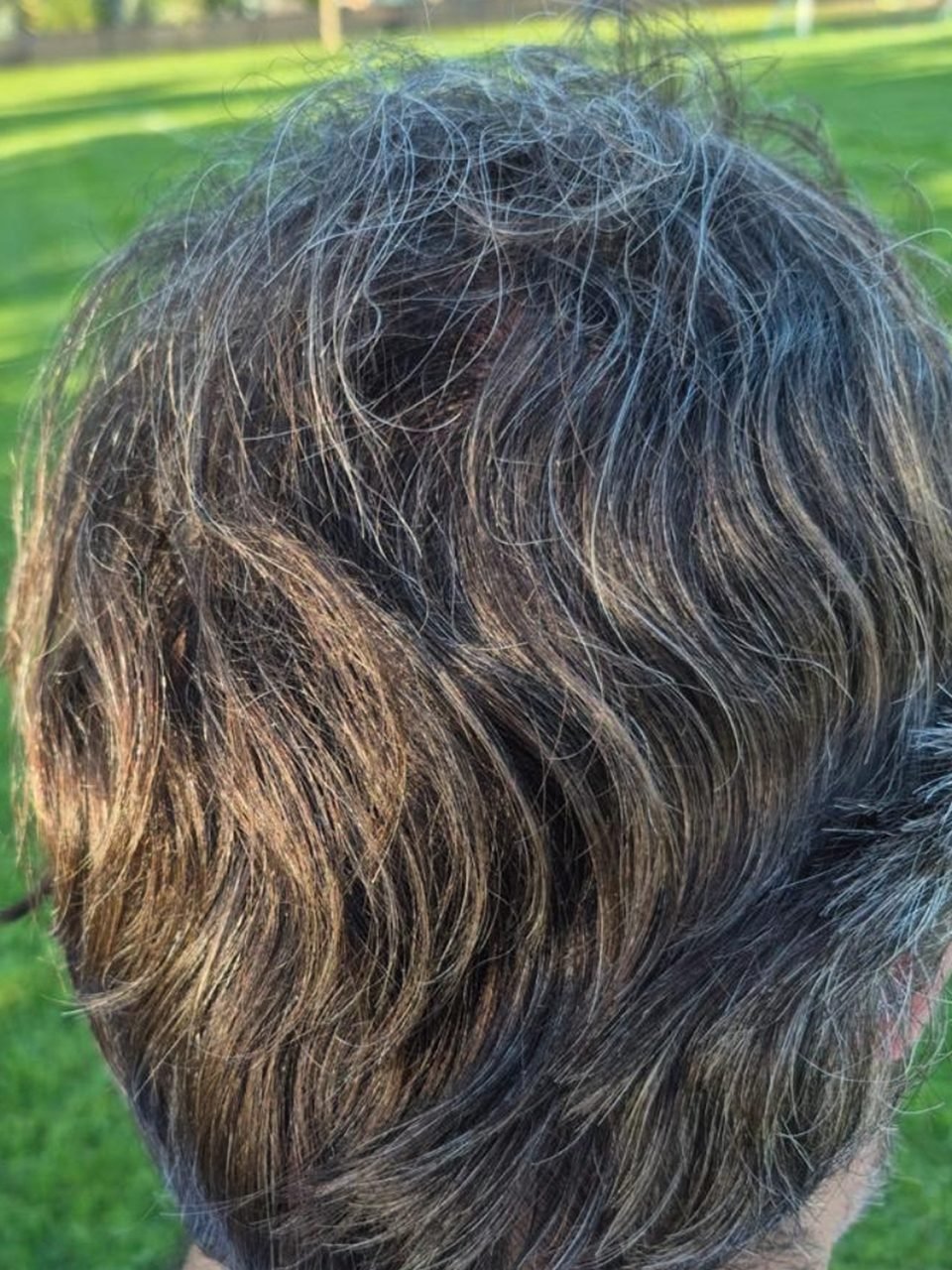 Vista posterior da cabeça logo após transplante capilar com a técnica FUE No-Shave, com o cabelo ao redor preservado cobrindo a área doadora