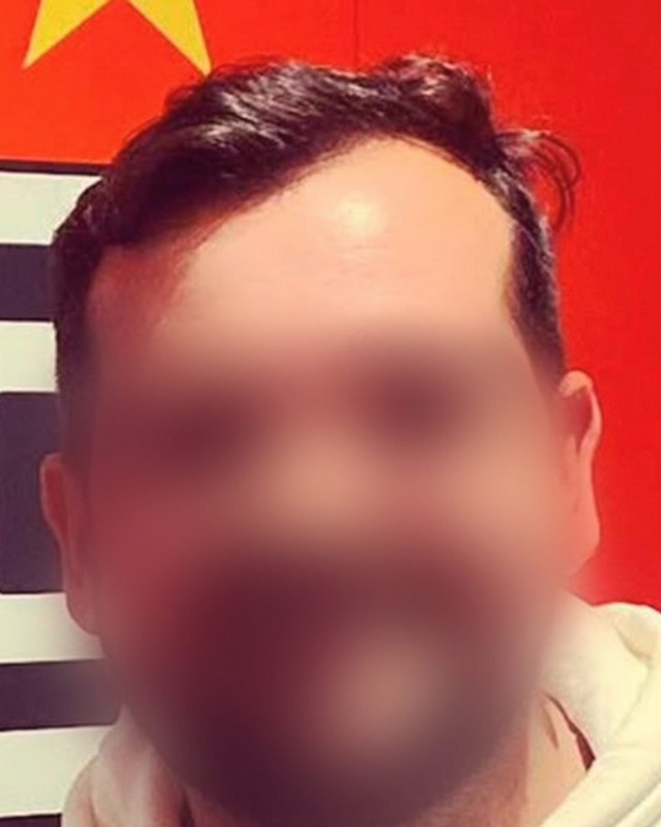 Paciente 1, antes do transplante capilar, com o rosto desfocado